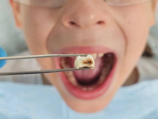 Best Emergency Dental Care for Broken or Chipped Teeth in Sandia Heights, NM